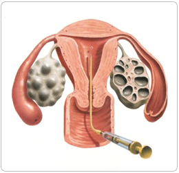 Aşılama (IUI) Tedavisi Nedir?